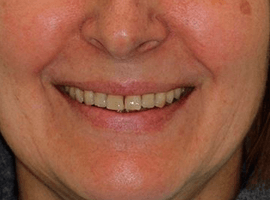 Имплантация зубов. Установка виниров Emax в линию улыбки