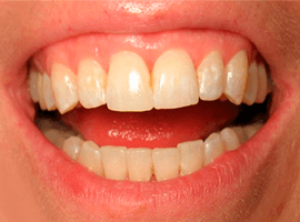 Выравнивание зубов элайнерами. Срок лечения - 1 год