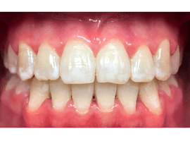 Выравнивание зубов элайнерами. Срок лечения - 1 год и 3 мес.