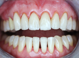 Установка виниров. Реставрация фронтальных зубов. Отбеливание