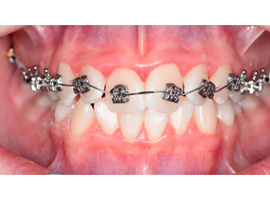 Сужение зубных рядом, исправление скученного положения зубов, срок лечения 1 год 1 мес.