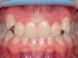 Исправление положения зубов, нормализация окклюзии. Срок лечения — 1 год