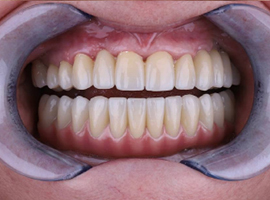 Имплантация зубов all-on-6. Перепротезирование зубов