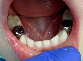 Лечение кариеса молочных зубов. Установка коронки