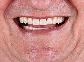 Тотальная реабилитация улыбки: имплантация зубов, установка коронок в боковые участки, керамические виниры