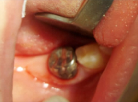 Установка коронки на молочные зубы